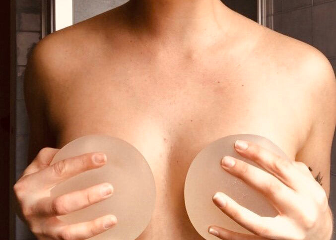 Community Story: Implant Removal